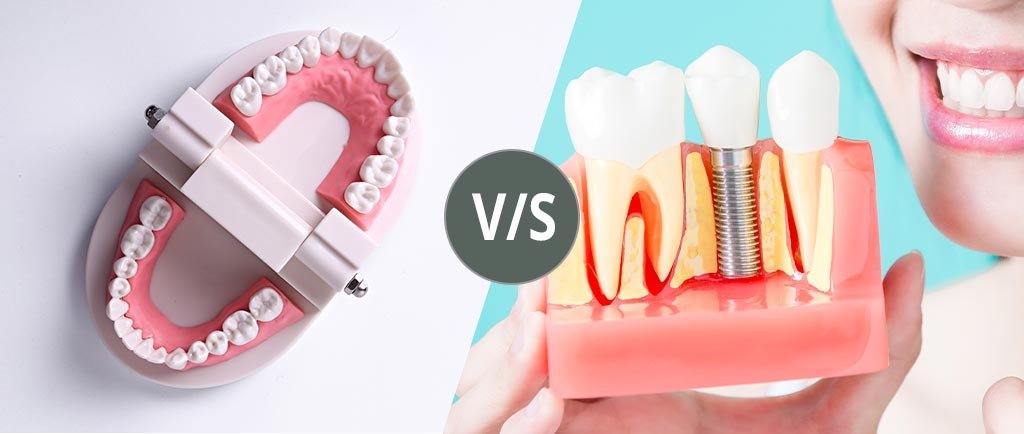 Dentures vs. Implants: Which Is Best For You?