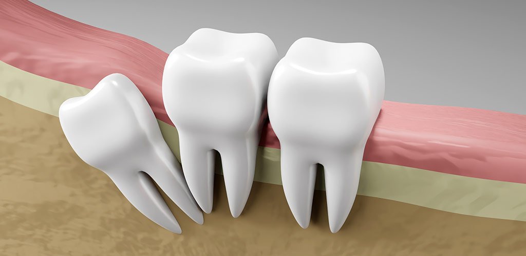 The most common myths and lies about wisdom teeth